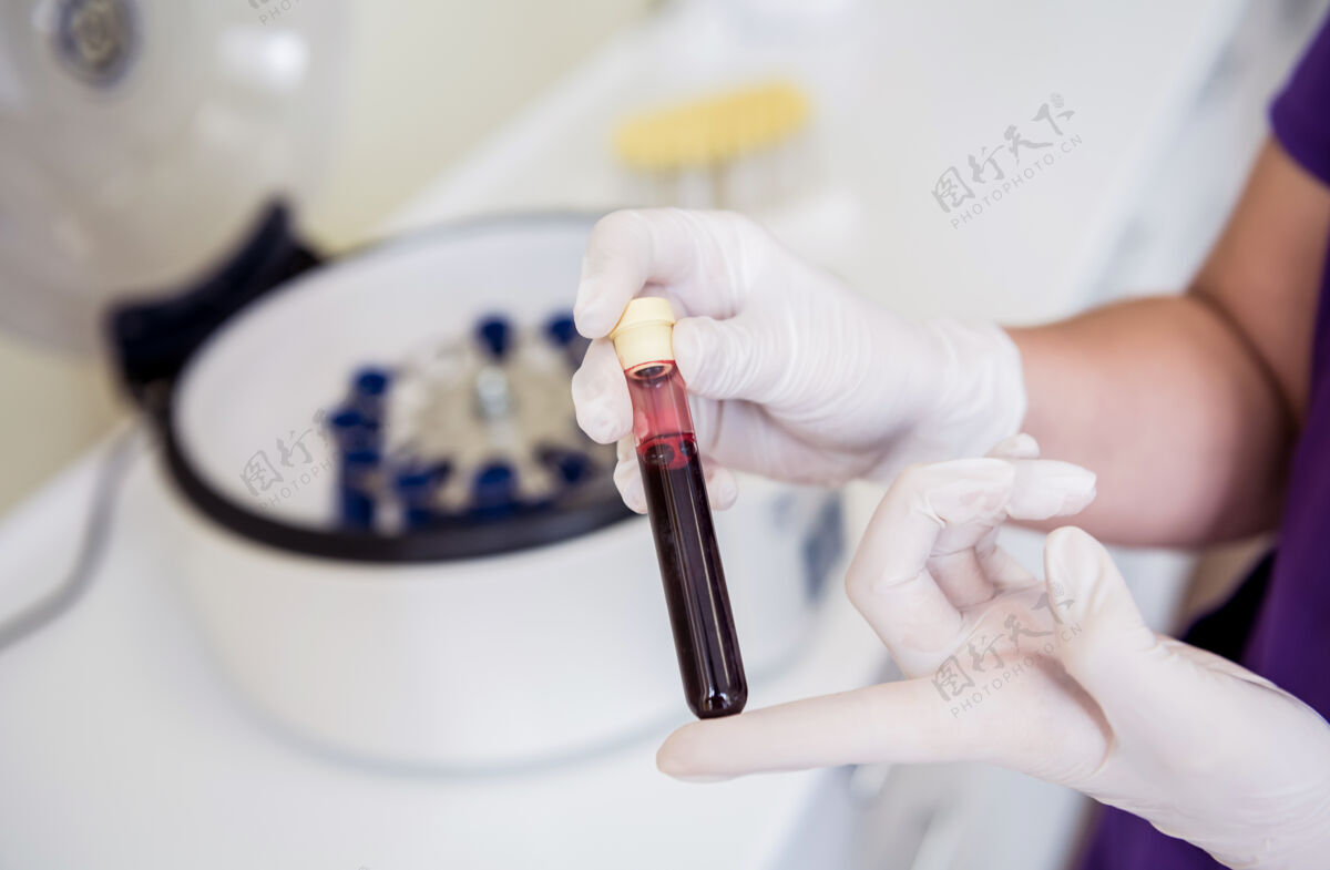 分析富血小板血浆制备管手上有血血浆技术人员科学