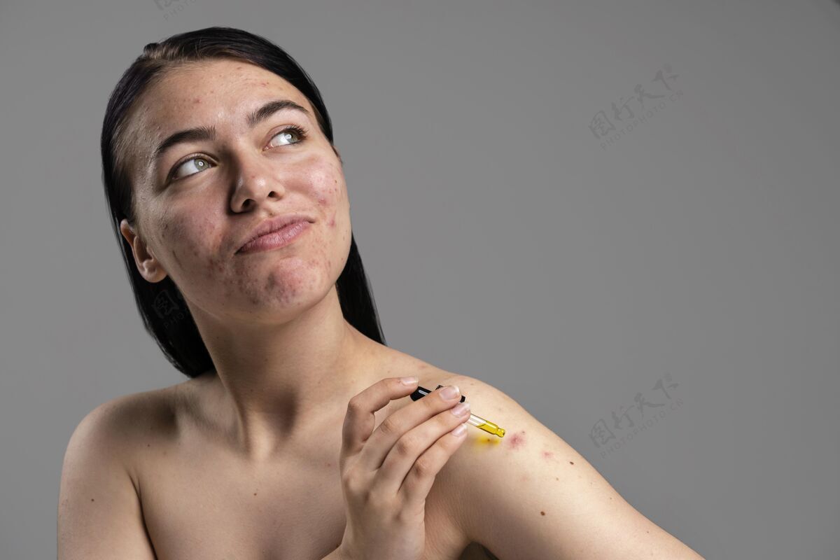 粉刺美丽的女人自信地展示她的粉刺皮肤护理皮肤科